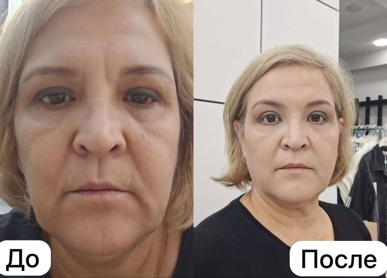 Результат на лице до и после